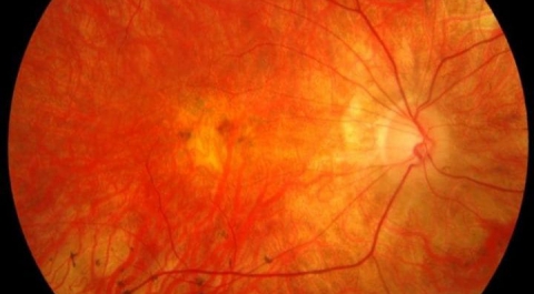 Новый тест на глаукому позволяет начать лечение до появления первых симптомов потери зрения